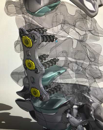 CAD for anterior cervical plate